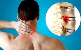 melyek a nyaki spondylosis tünetei