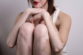 vitiligo doğal tedavi yöntemleri
